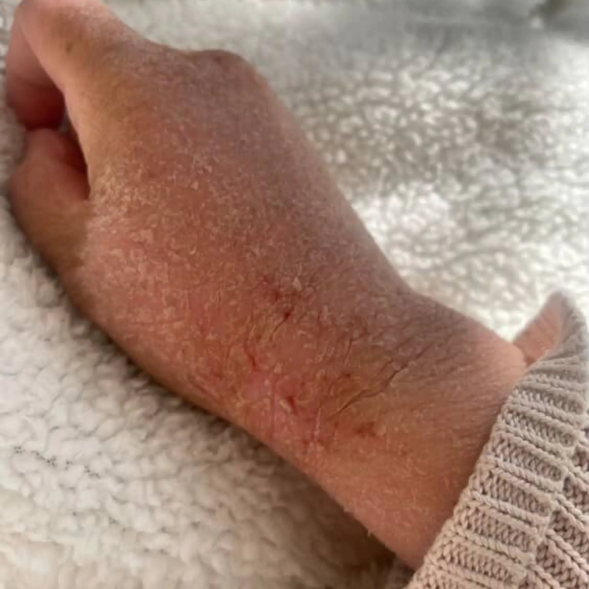 Eczema or Topical Steroid Withdrawal? How to Tell the Difference and Find Real Support