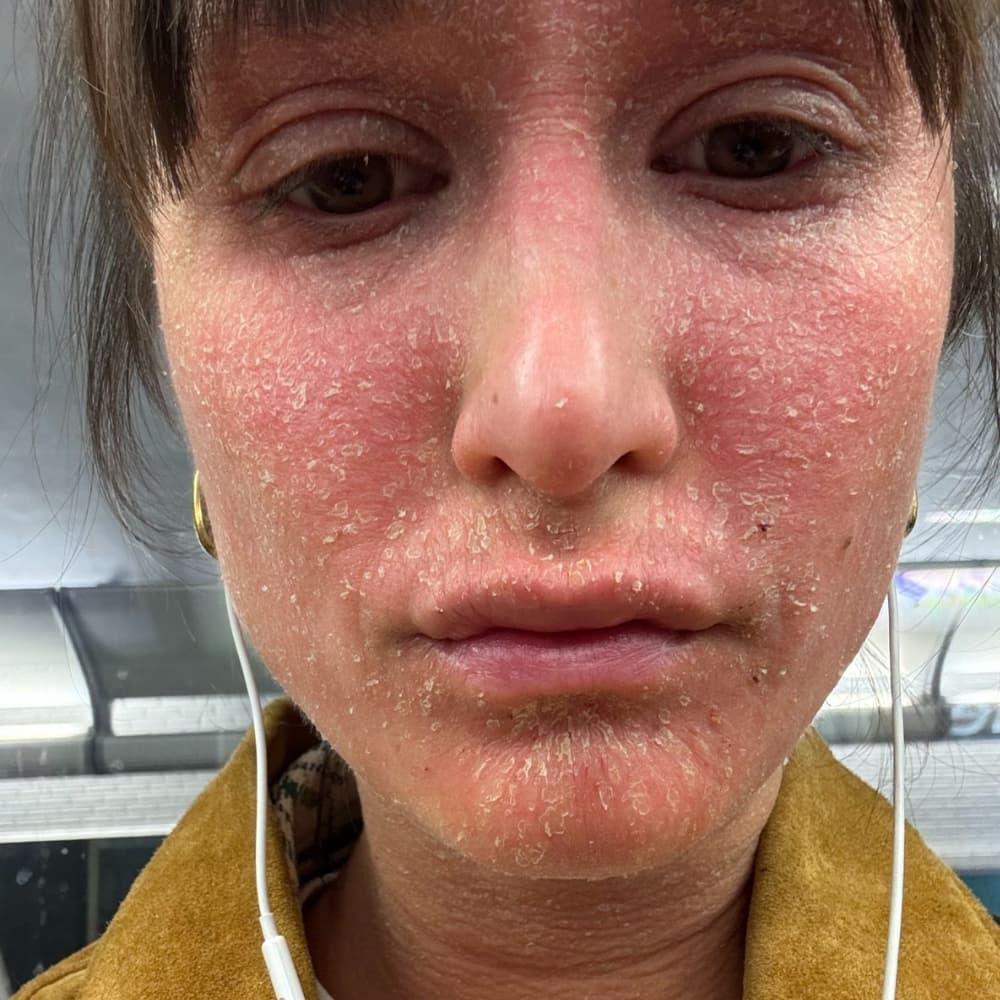 Eczema vs TSW: How Symptoms Overlap (and Why It’s Hard to Tell the Difference)