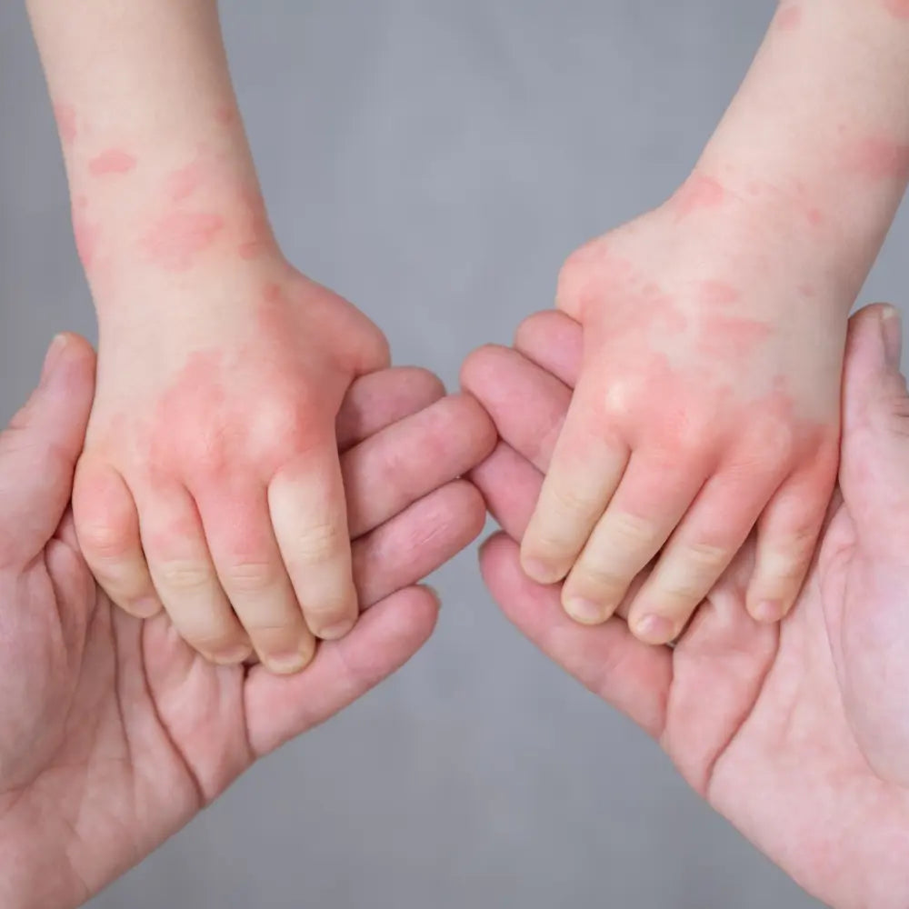 The Invisible Burden of Eczema: Why It's Never Just a Rash