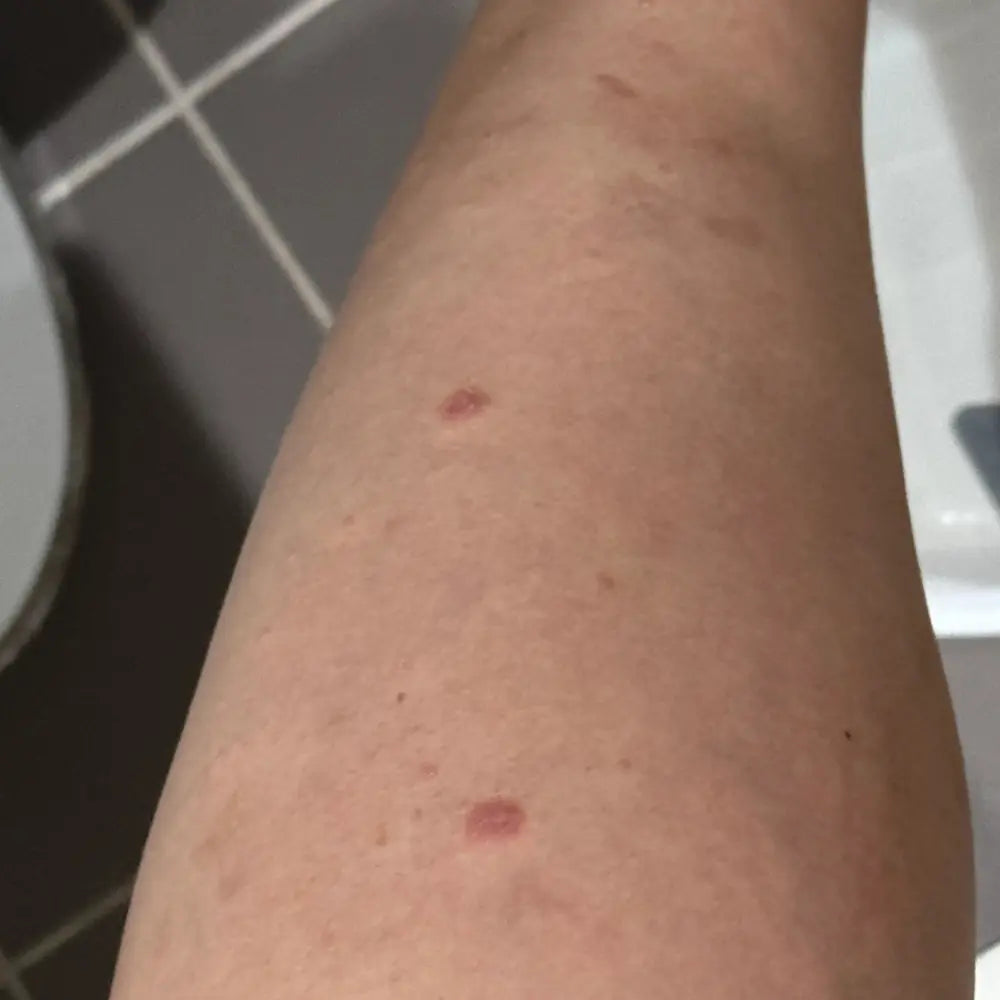 Psoriasis: the symptoms, the causes and the medical and natural ways to calm it