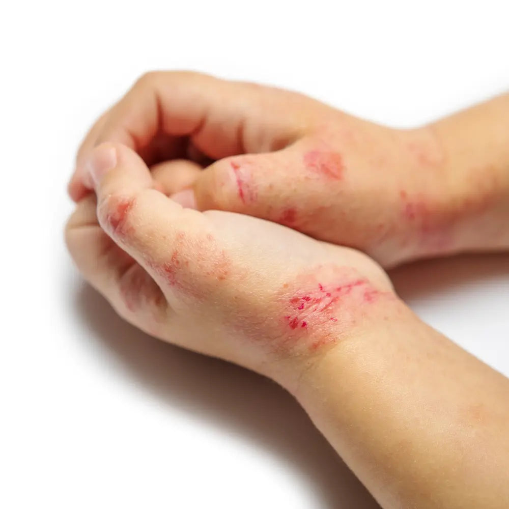 Eczema vs Dermatitis: What’s the Difference and How to Manage Both