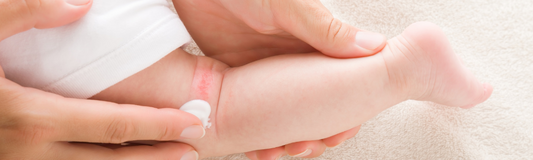 Eczema vs. Dermatitis: What’s the Difference?