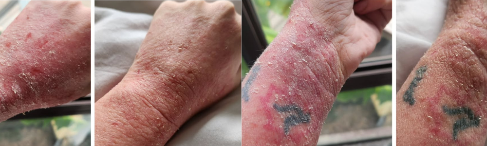 Topical Steroid Withdrawal (TSW): How to Soothe and Support Your Skin